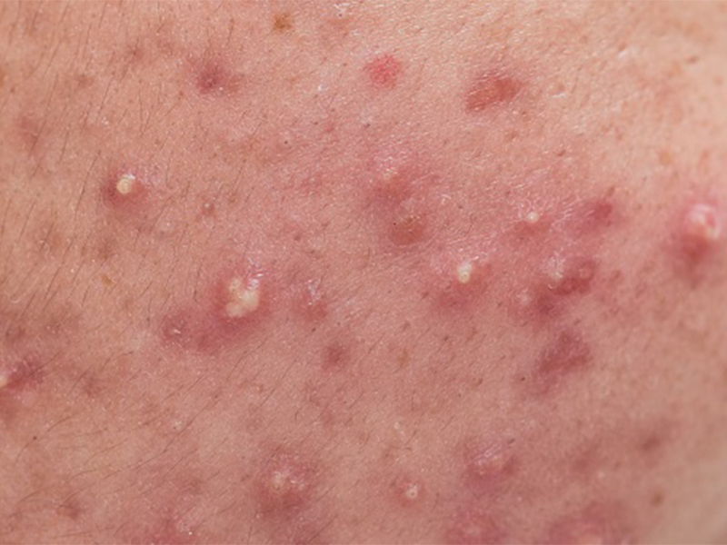 A close up of a person's skin with small red bumps caused by topical drug product formulation.